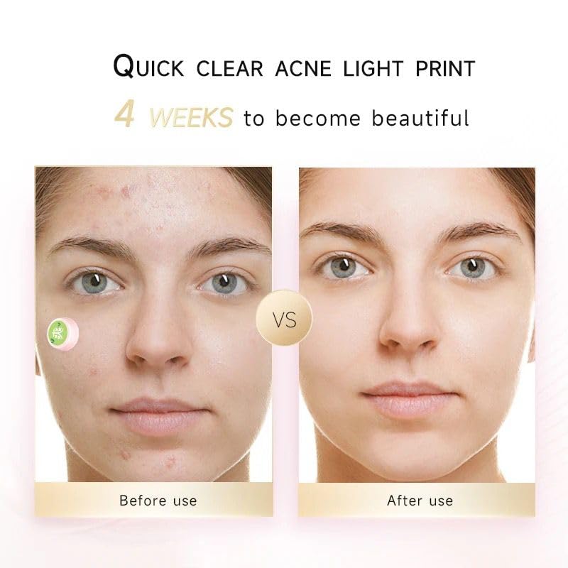 Electronic Acne Patches Light Therapy